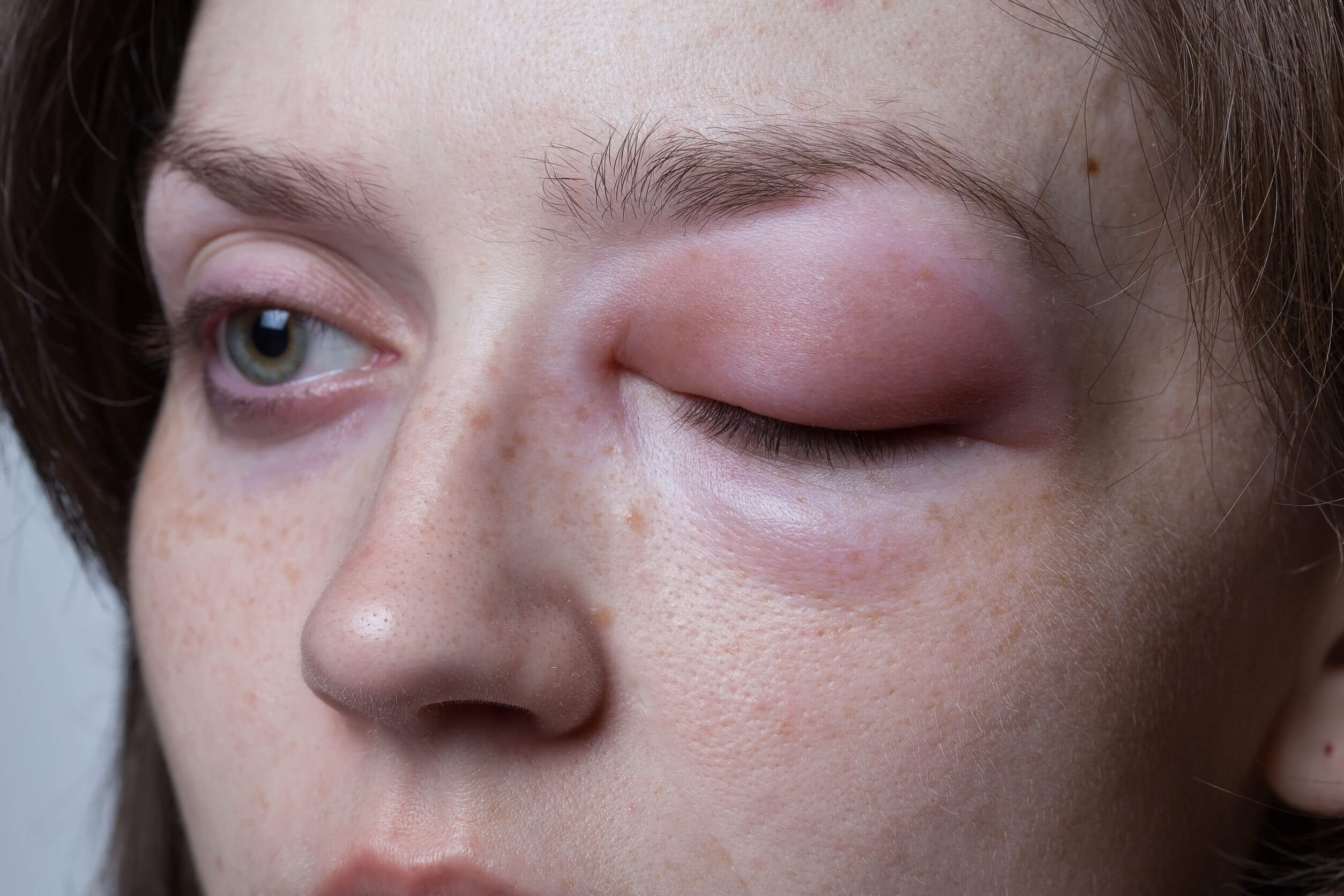 Allergic reactions can swell the eyes.