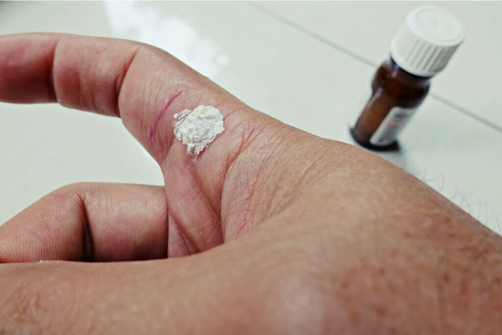 Ácido salicílico para las verrugas por VPH.