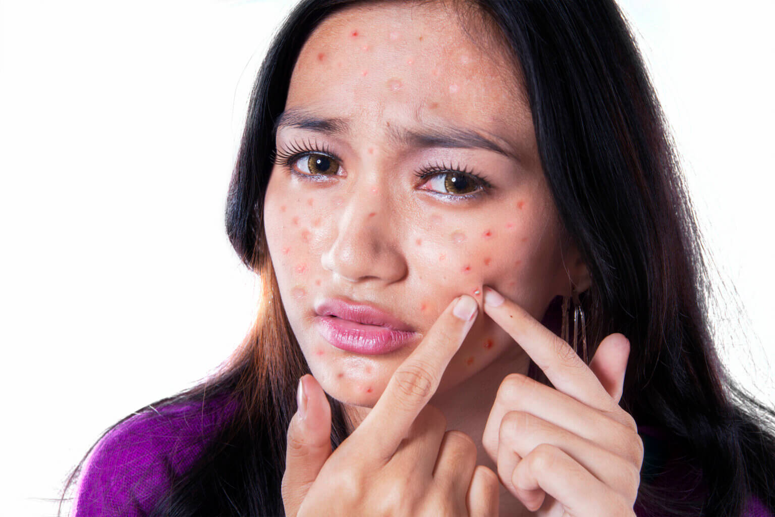 what-causes-pimples-on-your-face-and-how-to-get-rid-of-it-youtube