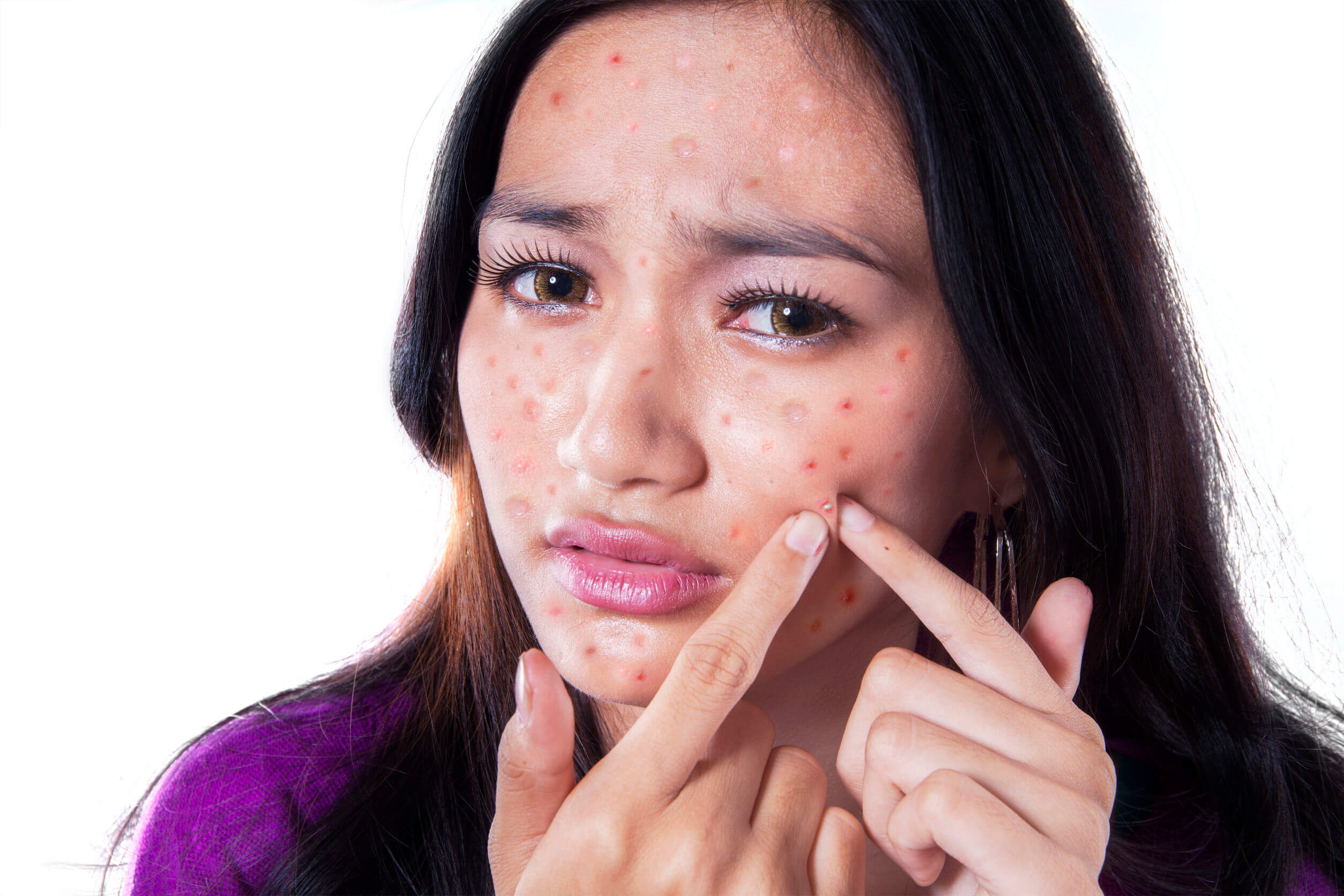 Pimples on the face can be very annoying.