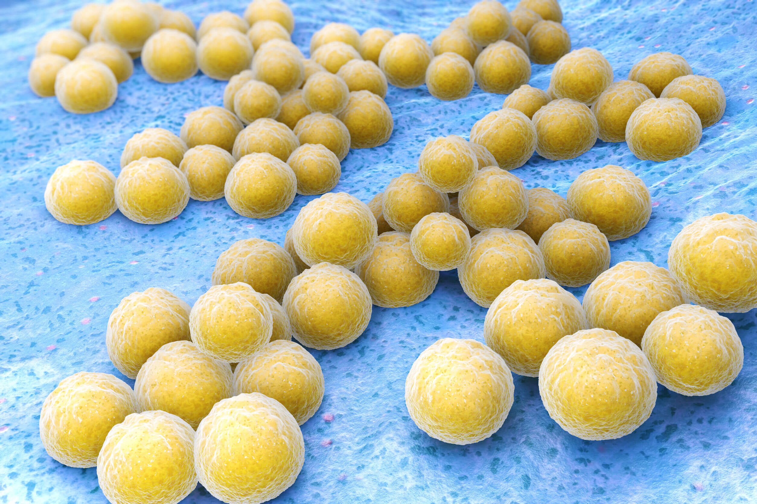 La neumonía bacteriana es causada por microorganismos