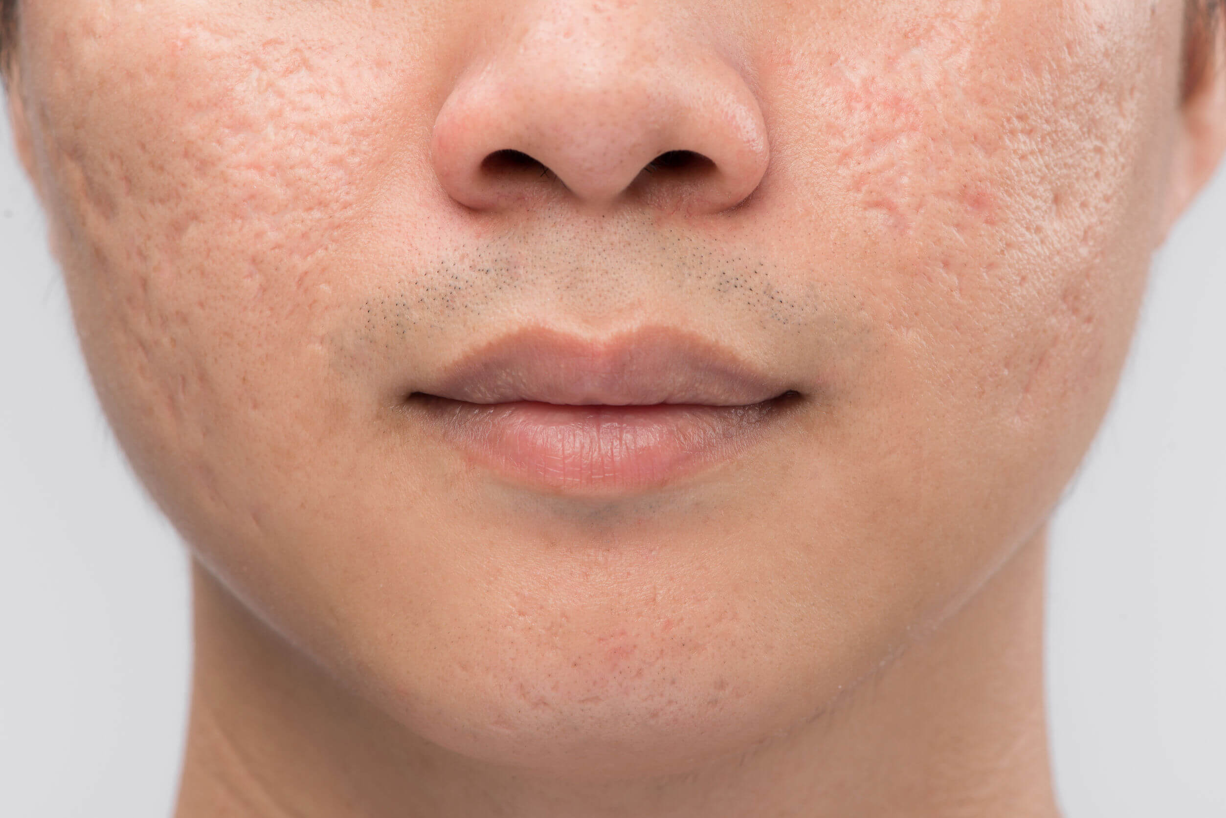 La piel grasa puede favorecer la aparición de acné y sus secuelas.