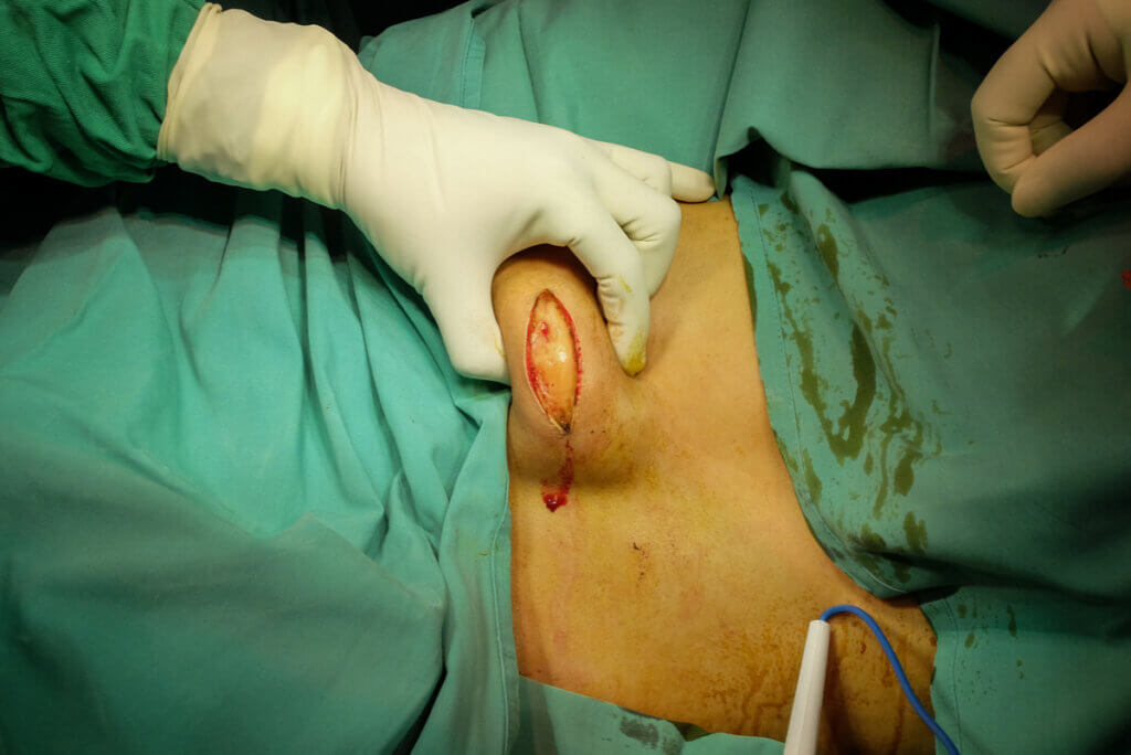 Cirugía de extirpación de lipoma.