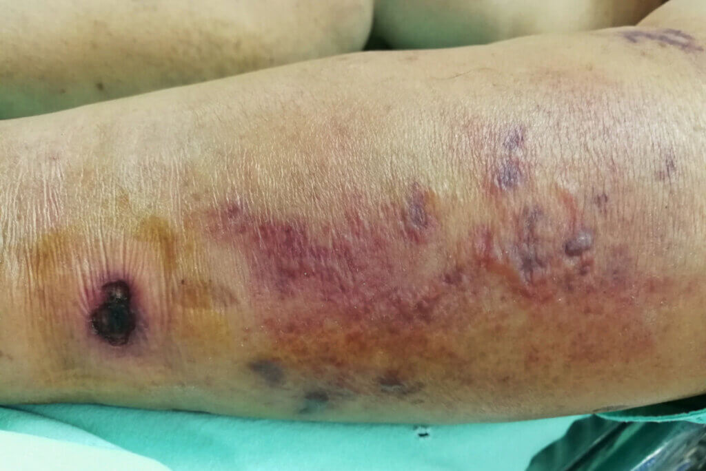 Gangrena que necesita extirpación del miembro.