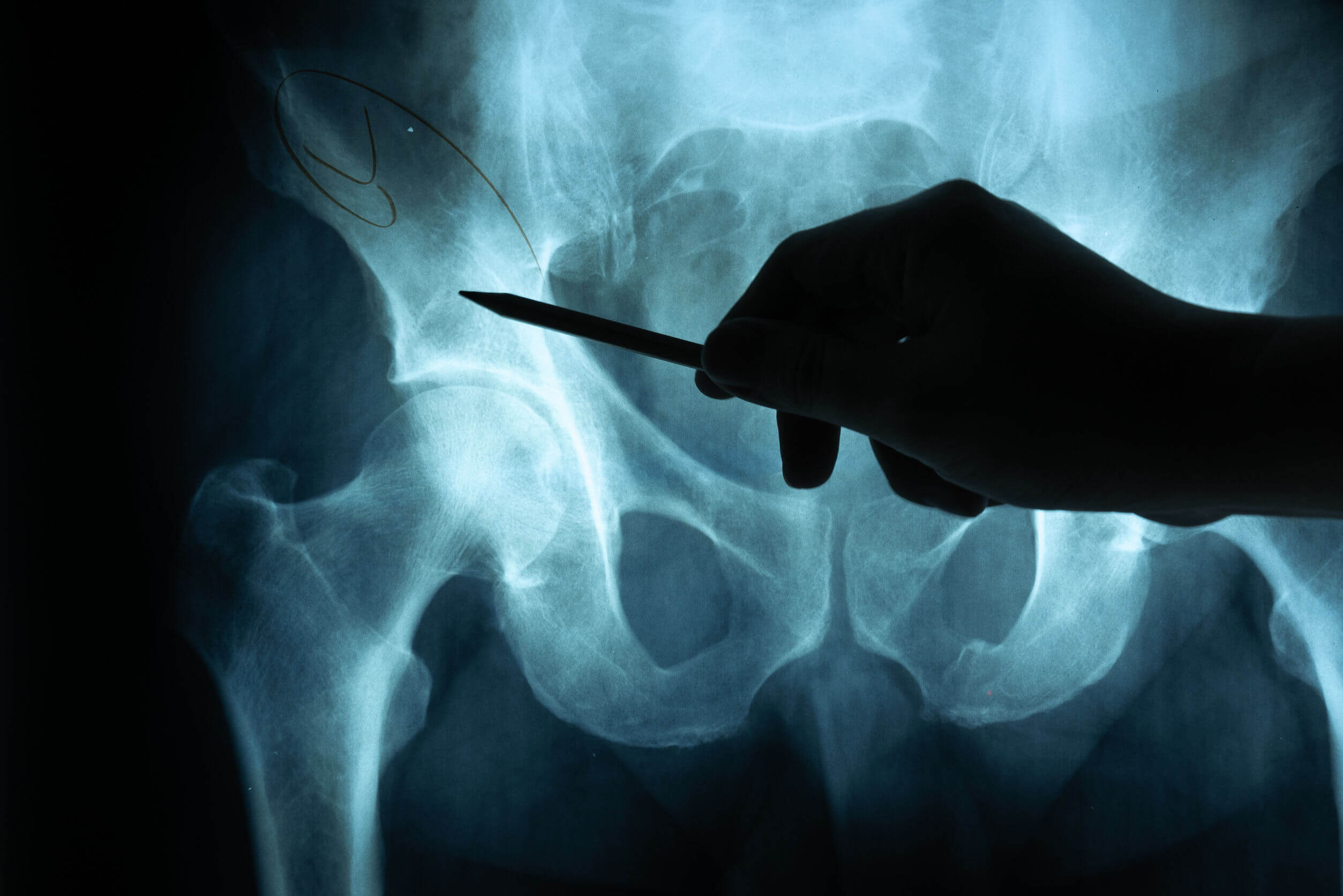 Hip fractures are very common in older adults.