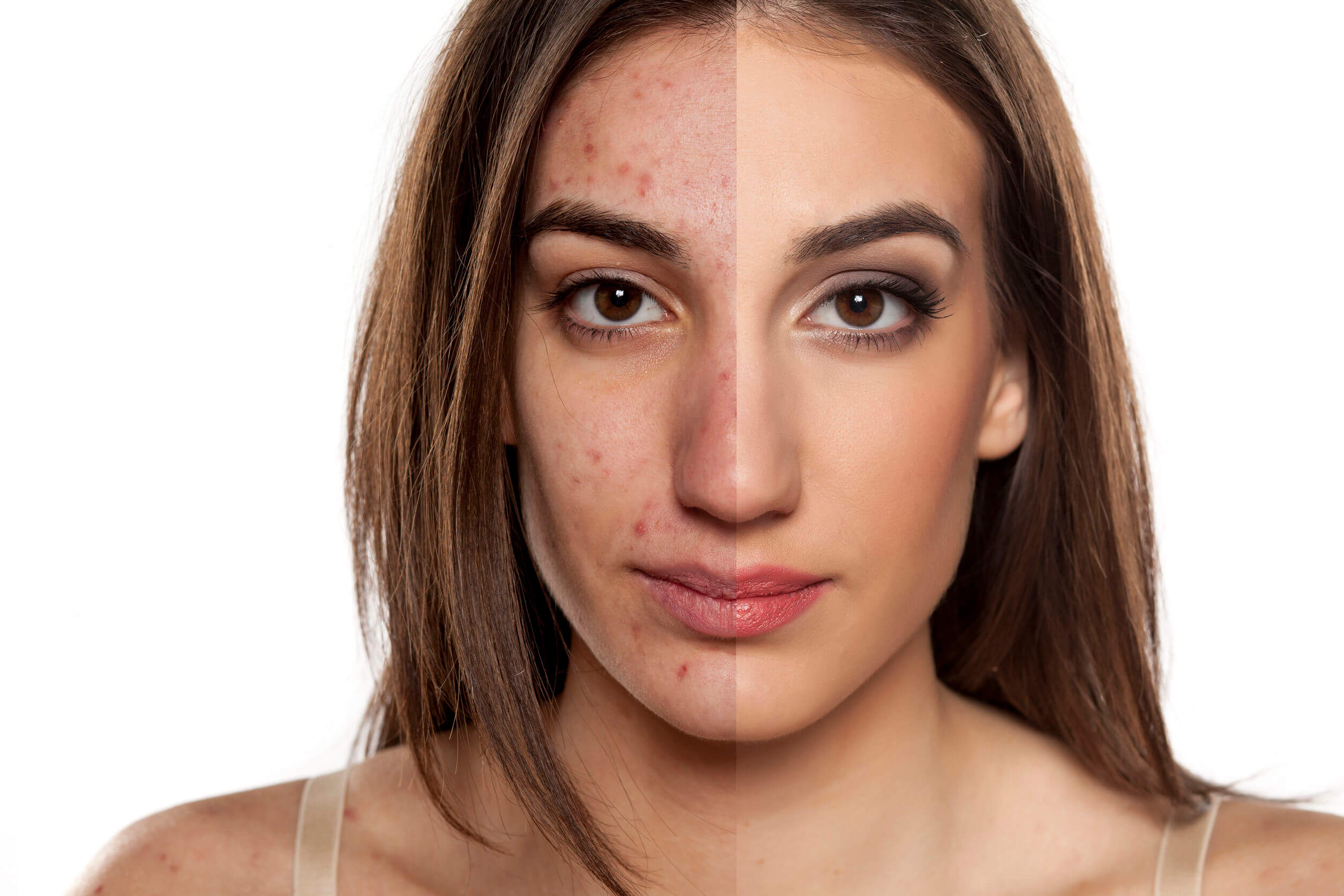 El maskné aparece como consecuencia del uso prolongado de mascarilla.