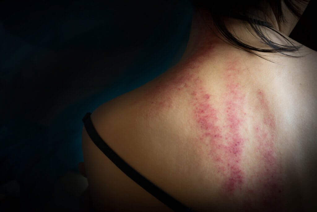 Marcas por violencia en una mujer.