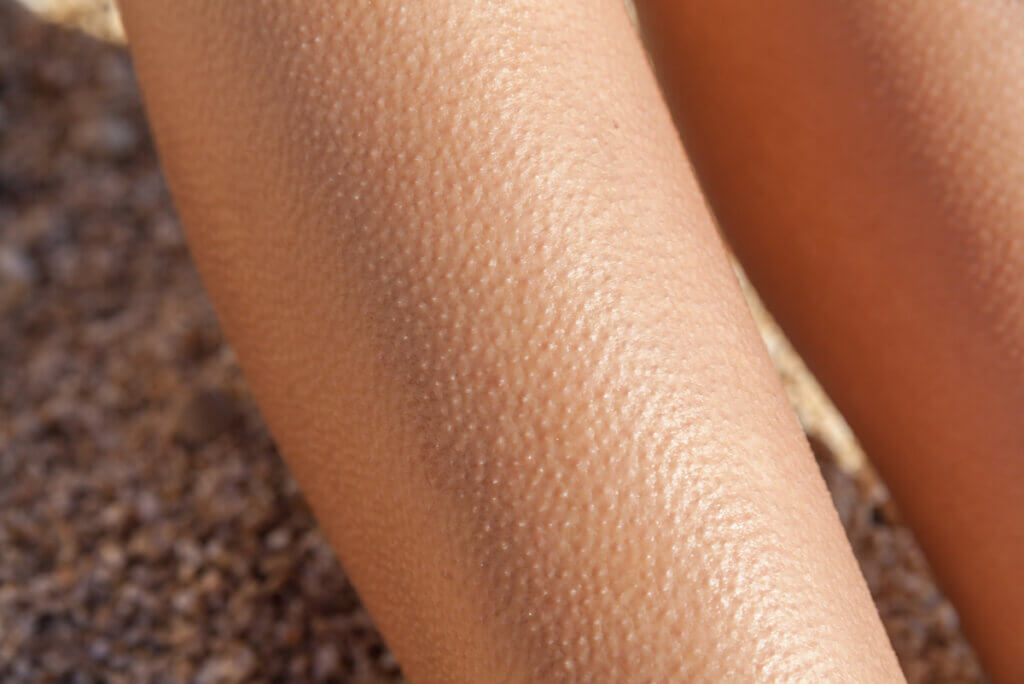 Urticaria por frío es más que piel de gallina.
