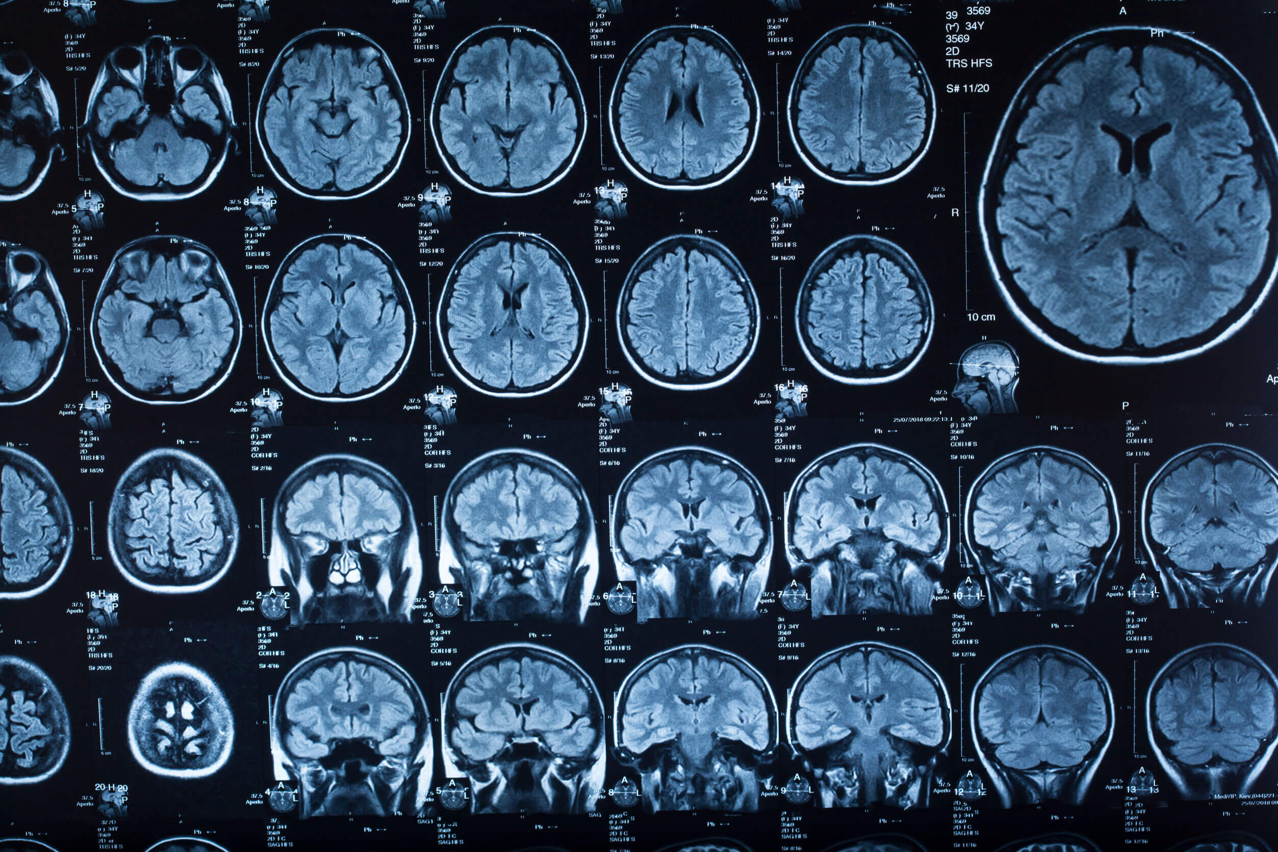 Radiographies de cerveaux. 