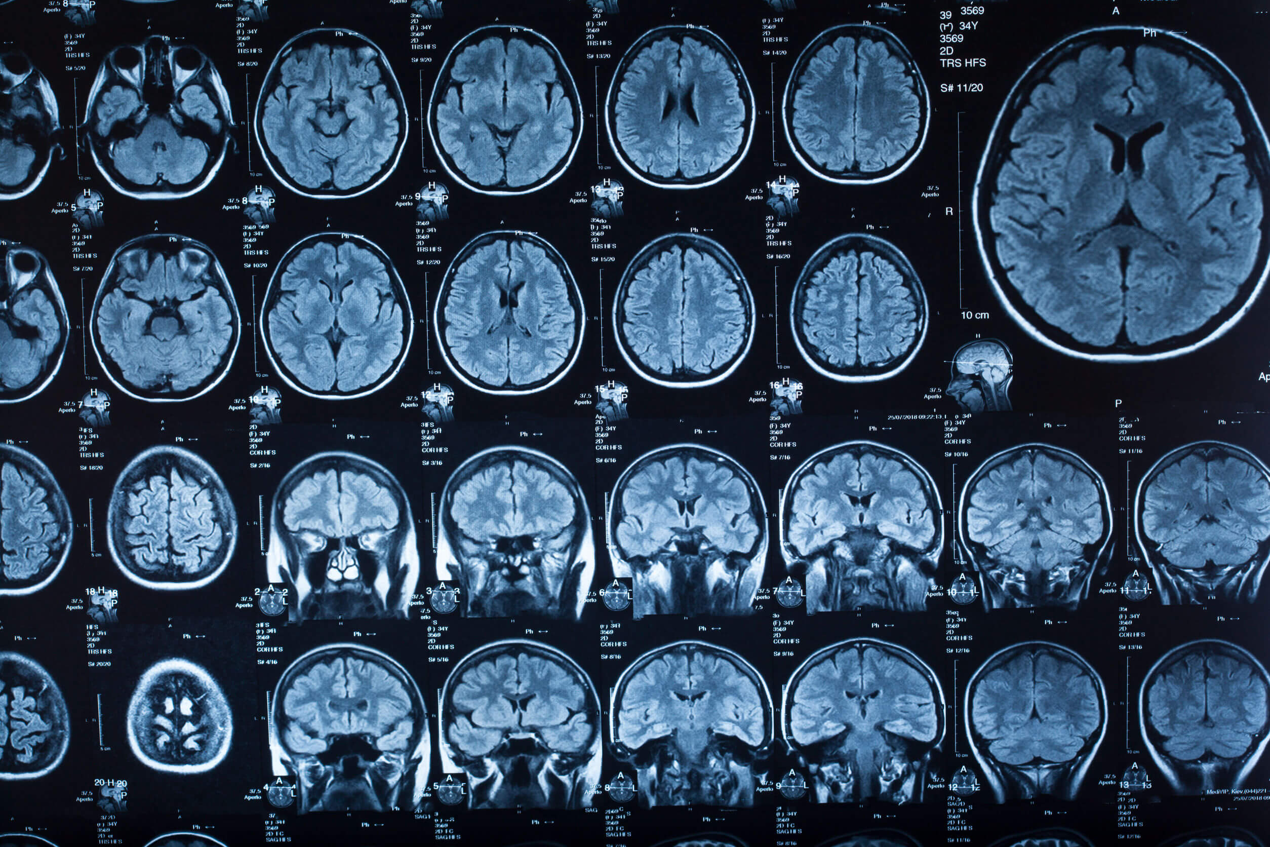 El diagnóstico de la meningitis incluye la resonancia magnética