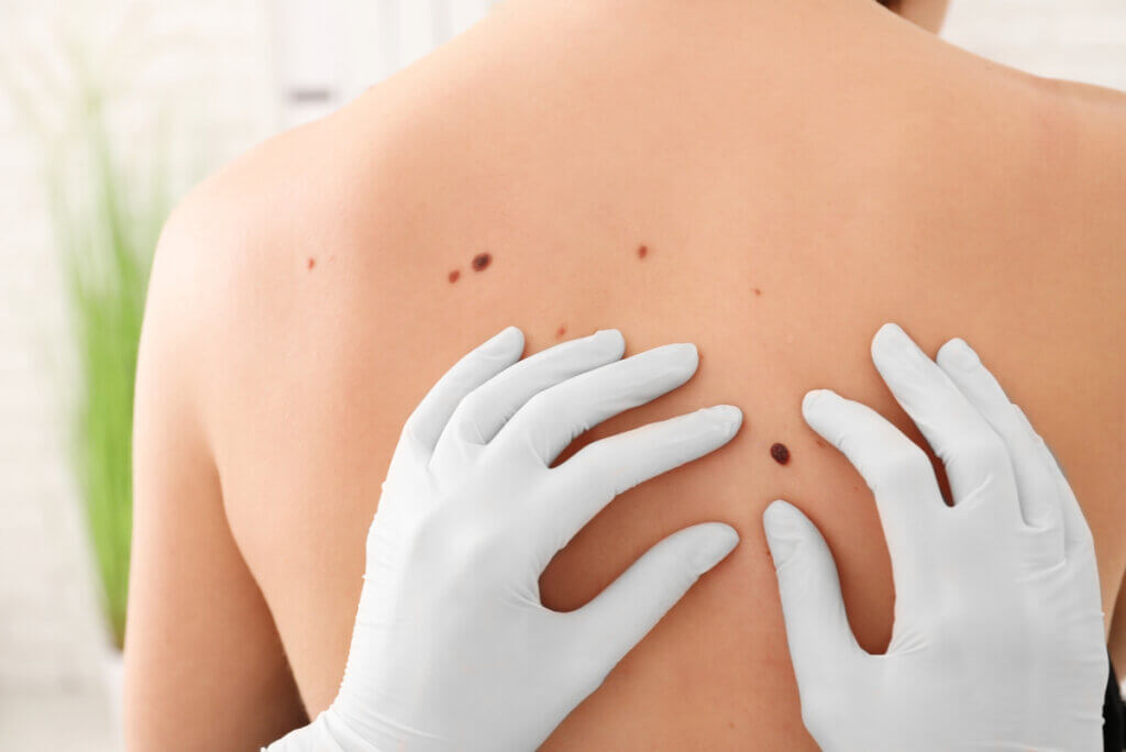 Melanoma revisado en la espalda.
