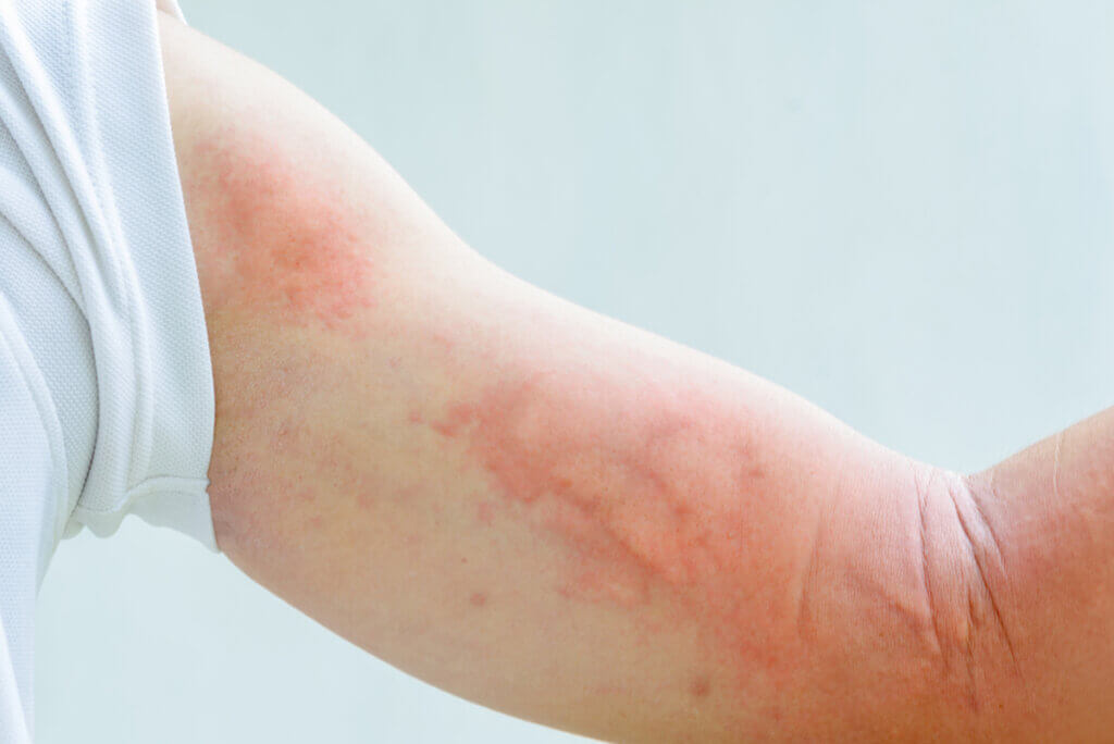 Urticaria on the arm due to allergy to humidity.