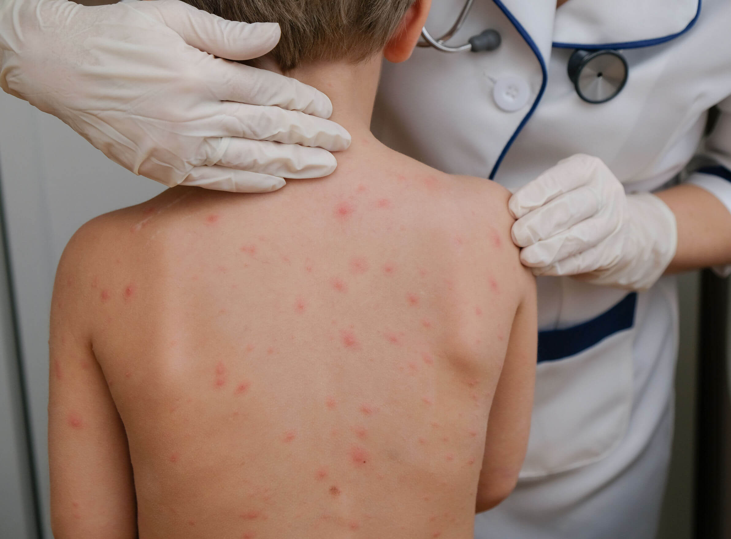 The most contagious diseases include measles