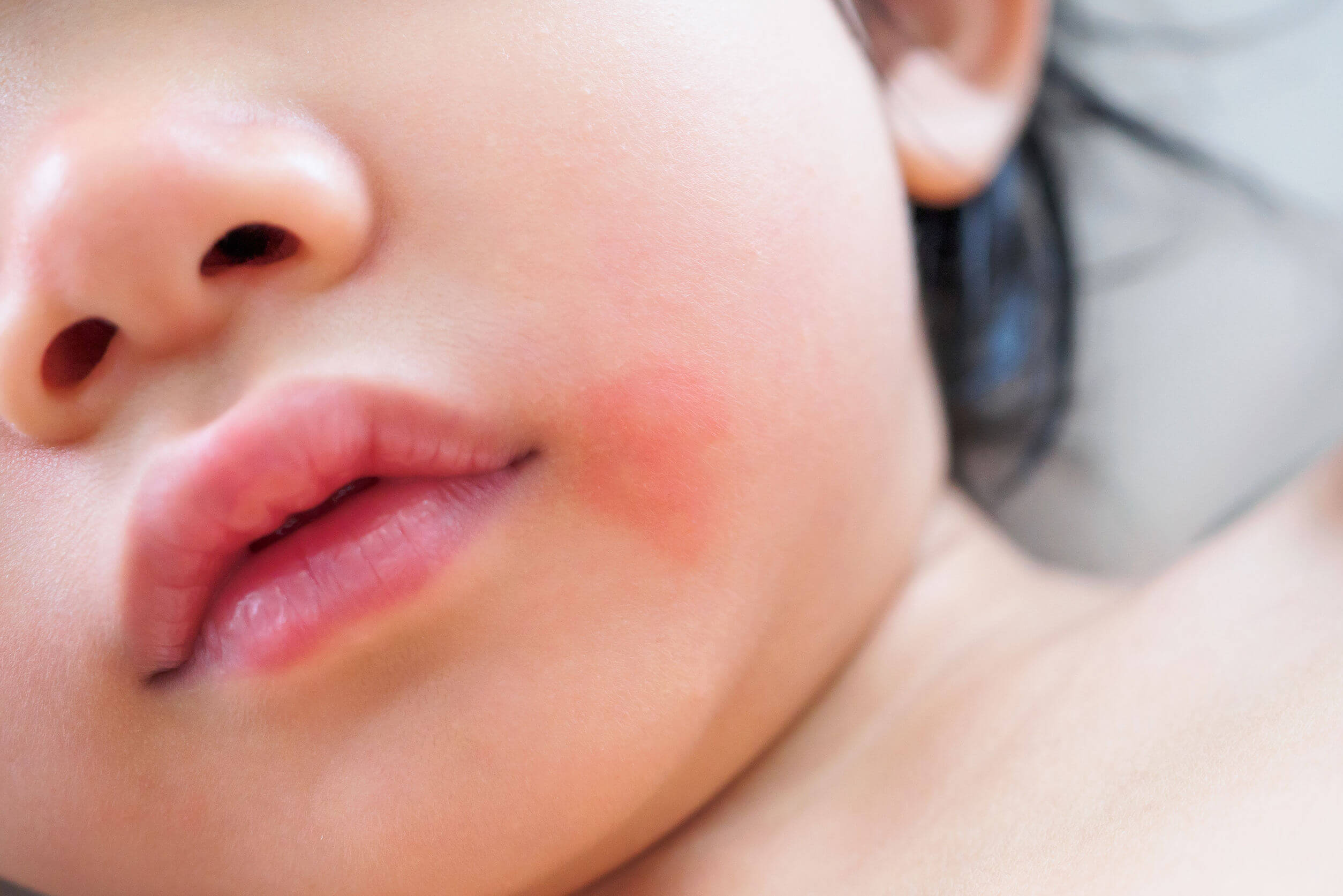 Las manchas rojas en la piel incluyen las alergias.