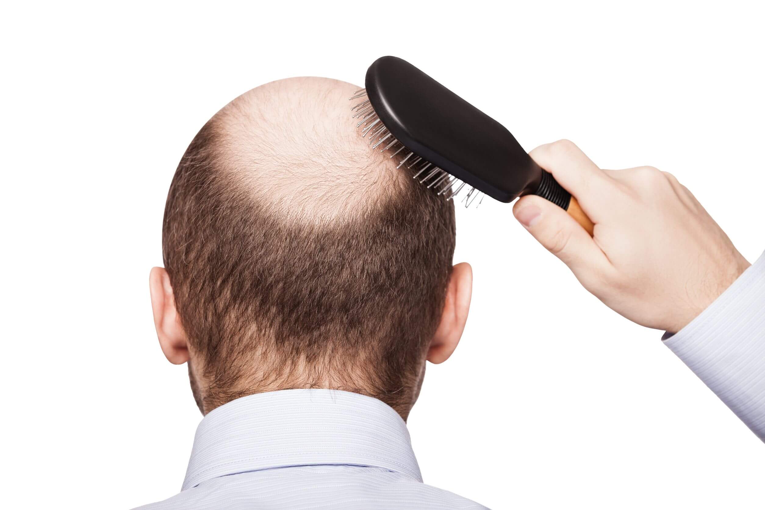 Las enfermedades comunes en hombres incluyen la alopecia androgénica.