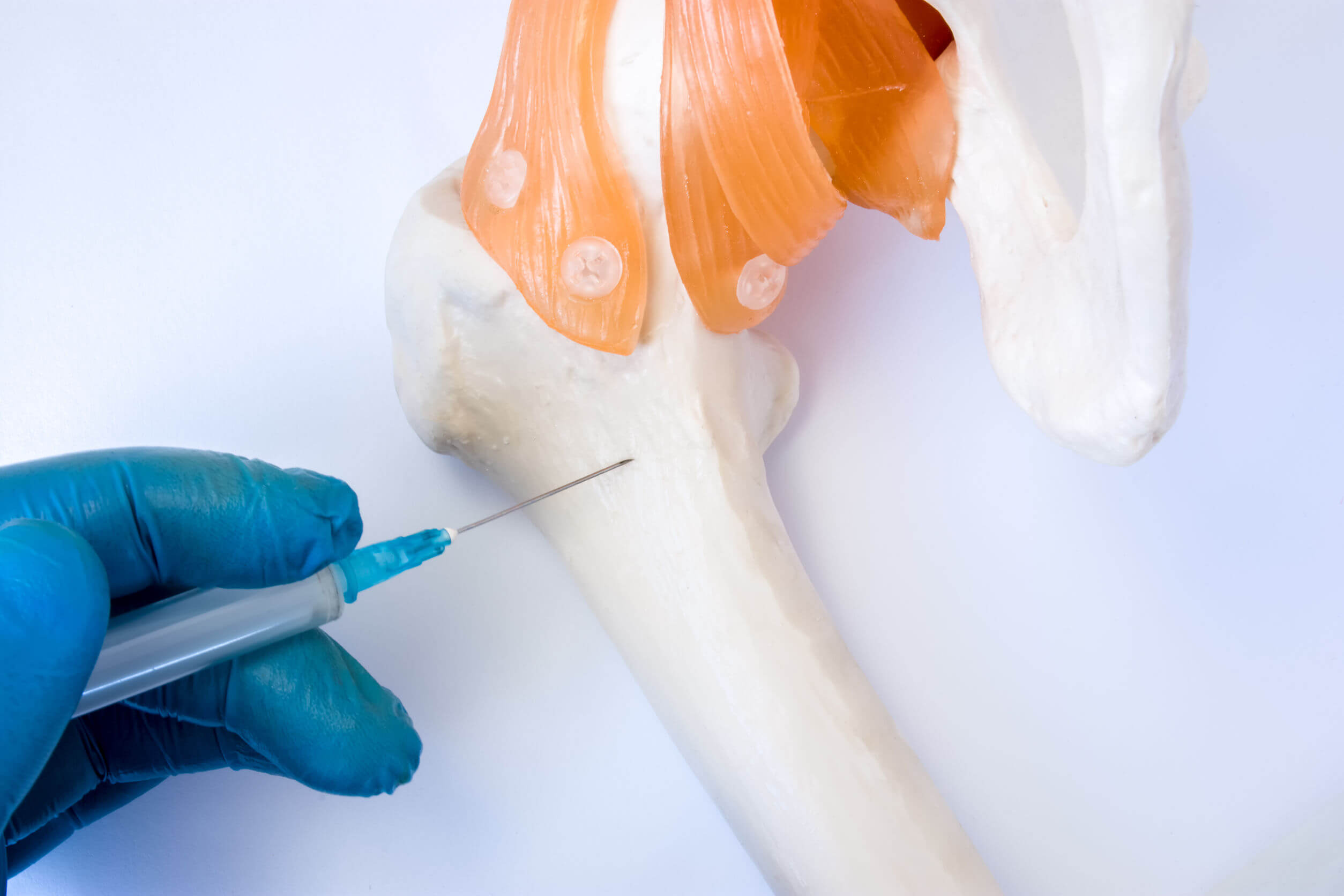 La leucemia tiene su origen en la médula ósea.