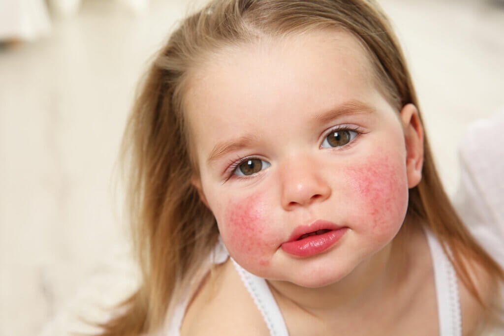 Macchie rosse sulla pelle: cause e trattamento