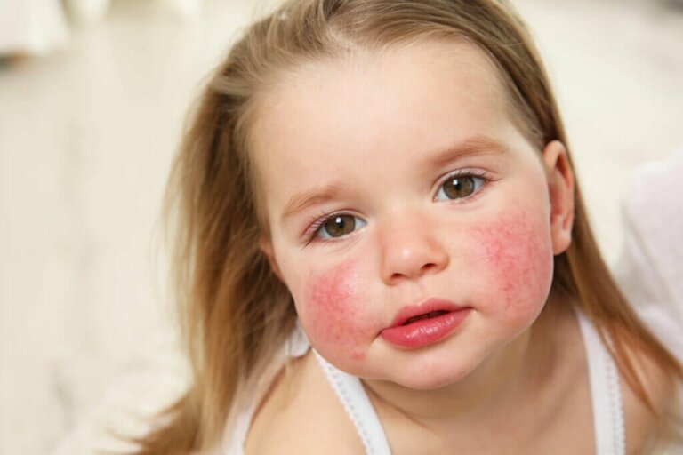 Taches rouges sur la peau: causes, symptômes et traitement