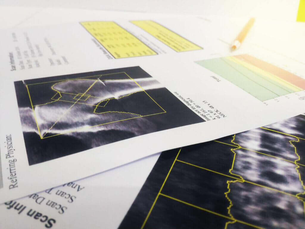 Entre las enfermedades más comunes en mujeres destaca la osteoporosis.