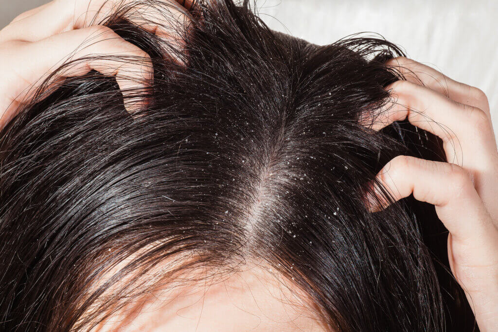 Why Does Dandruff Occur and How to Prevent it?