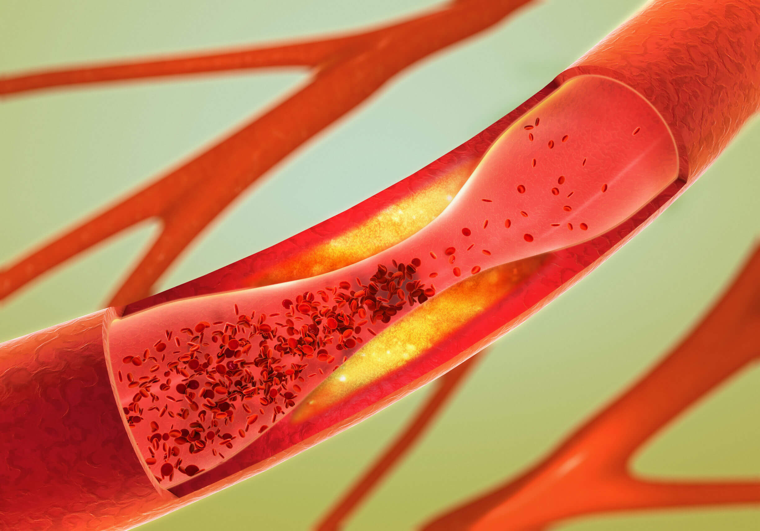 Los alimentos para bajar el colesterol malo pueden provocar problemas en las arterias.