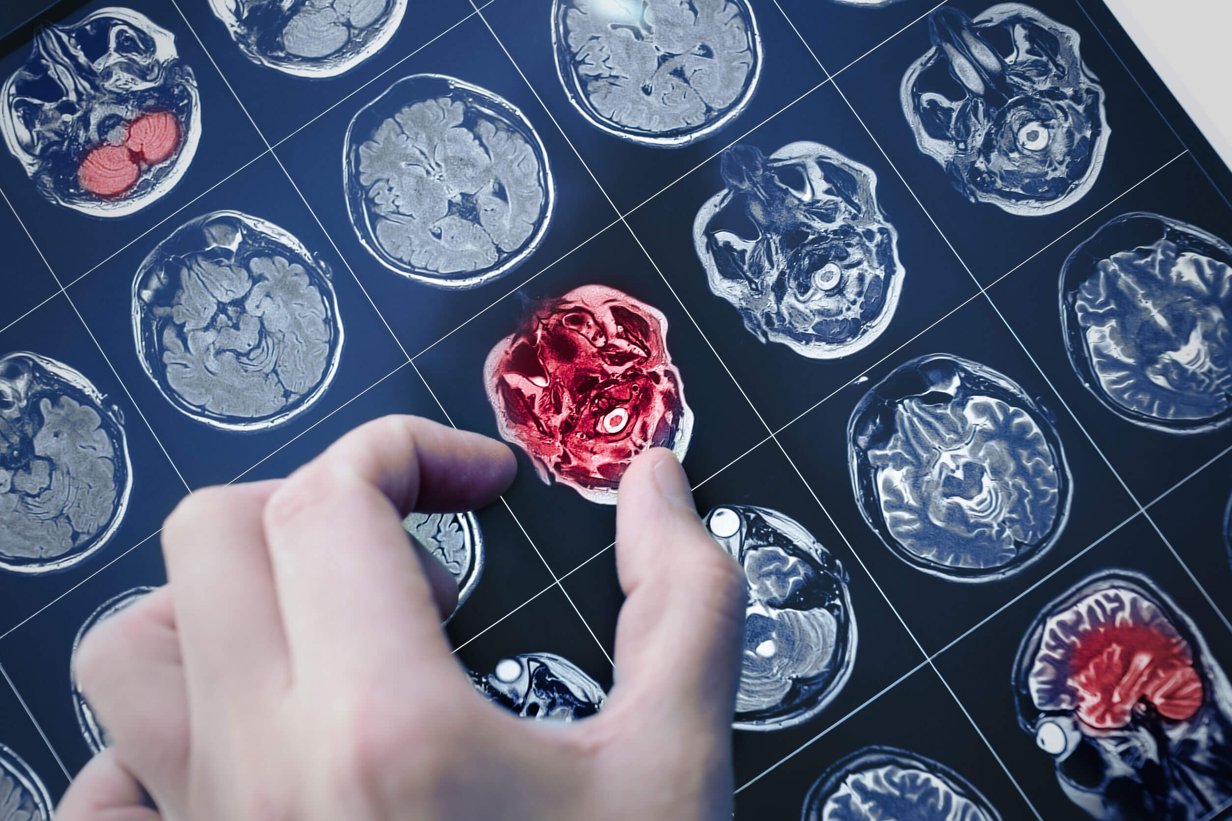 El glioma cerebral se detecta con técnicas de imagen.