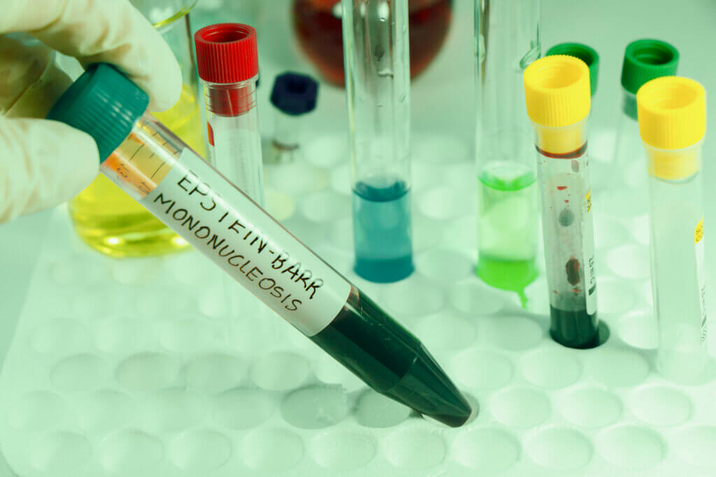 La mononucleosis se diagnostica con exámenes de laboratorio.