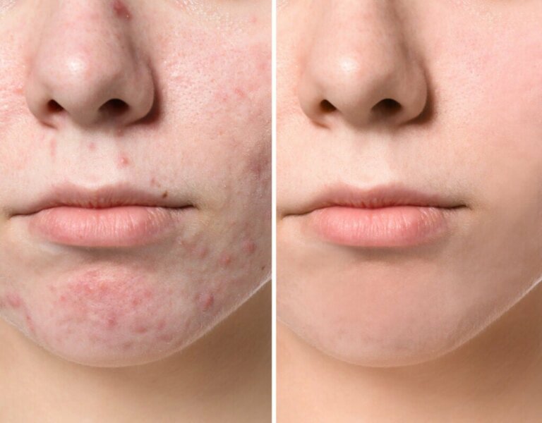 6 Types of Pimples on the Face and How to Treat Them