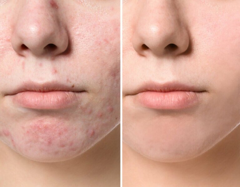 Normal Pimples 6 types of pimples on the face and how to treat them - Muy Salud