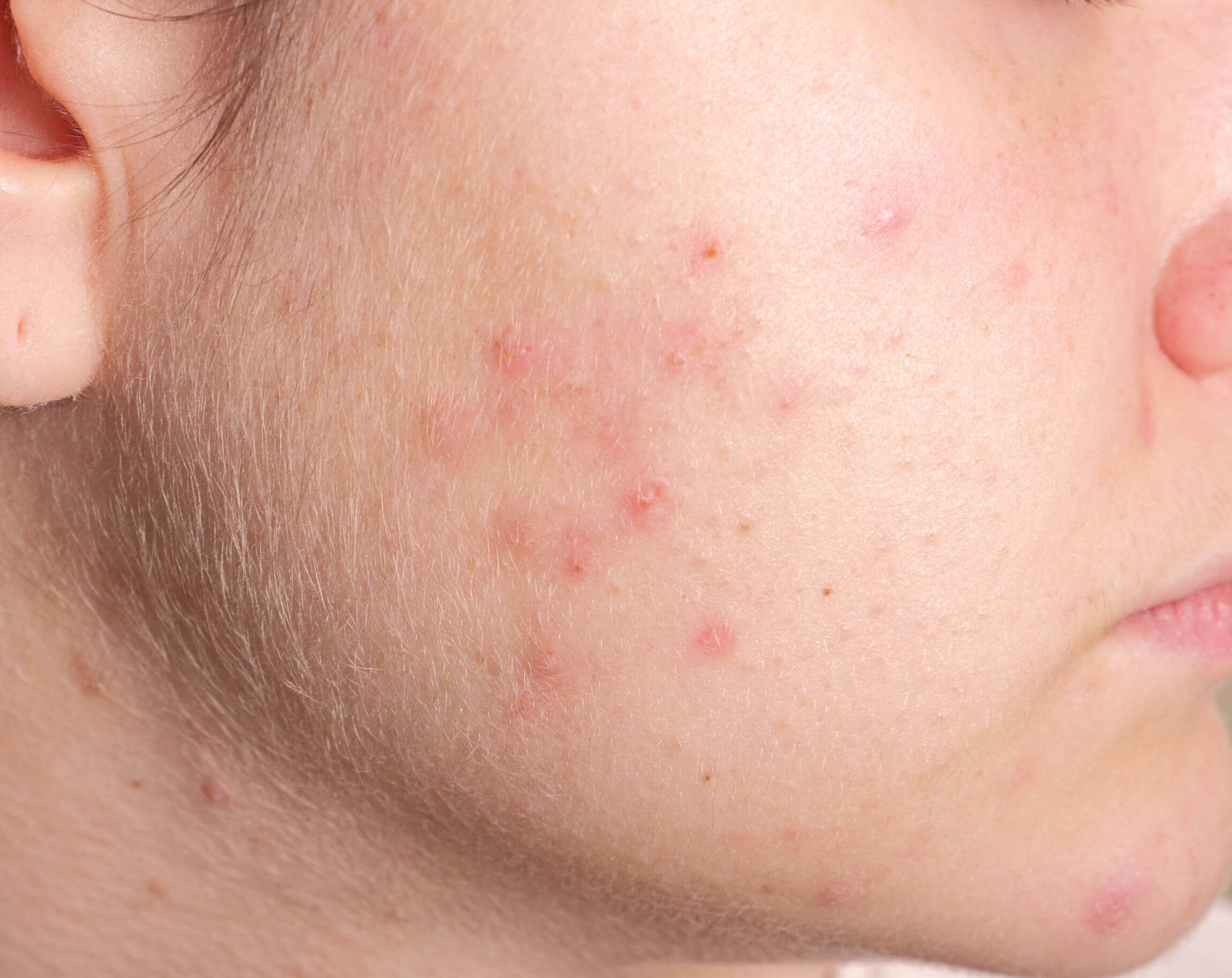 Infantile acne is easy to recognize.