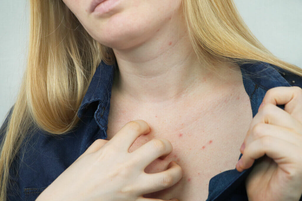 Une femme souffrant d'irritation cutanée dans la région de la poitrine. 