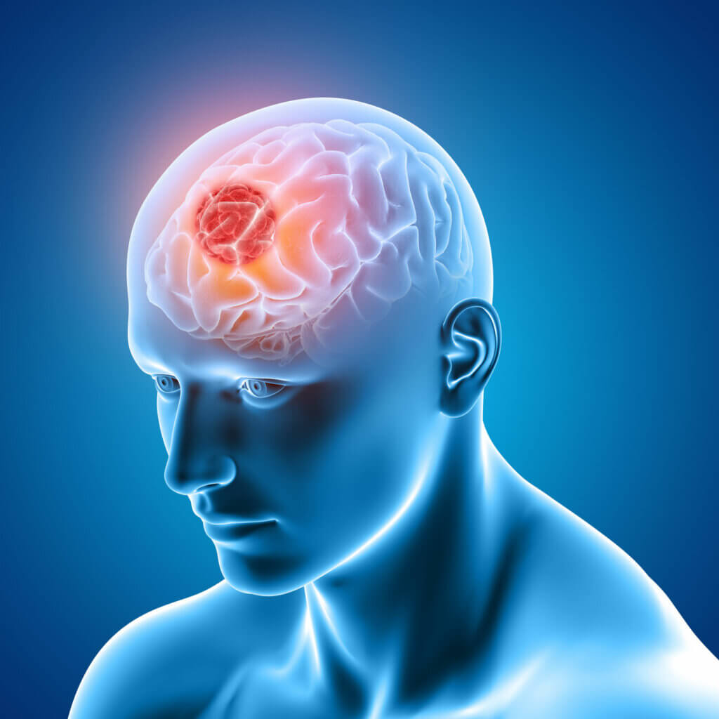 ¿Qué es el glioma cerebral? Muy Salud