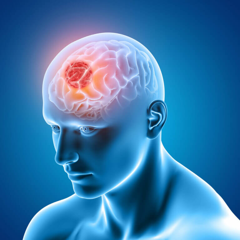 ¿Qué es el glioma cerebral?