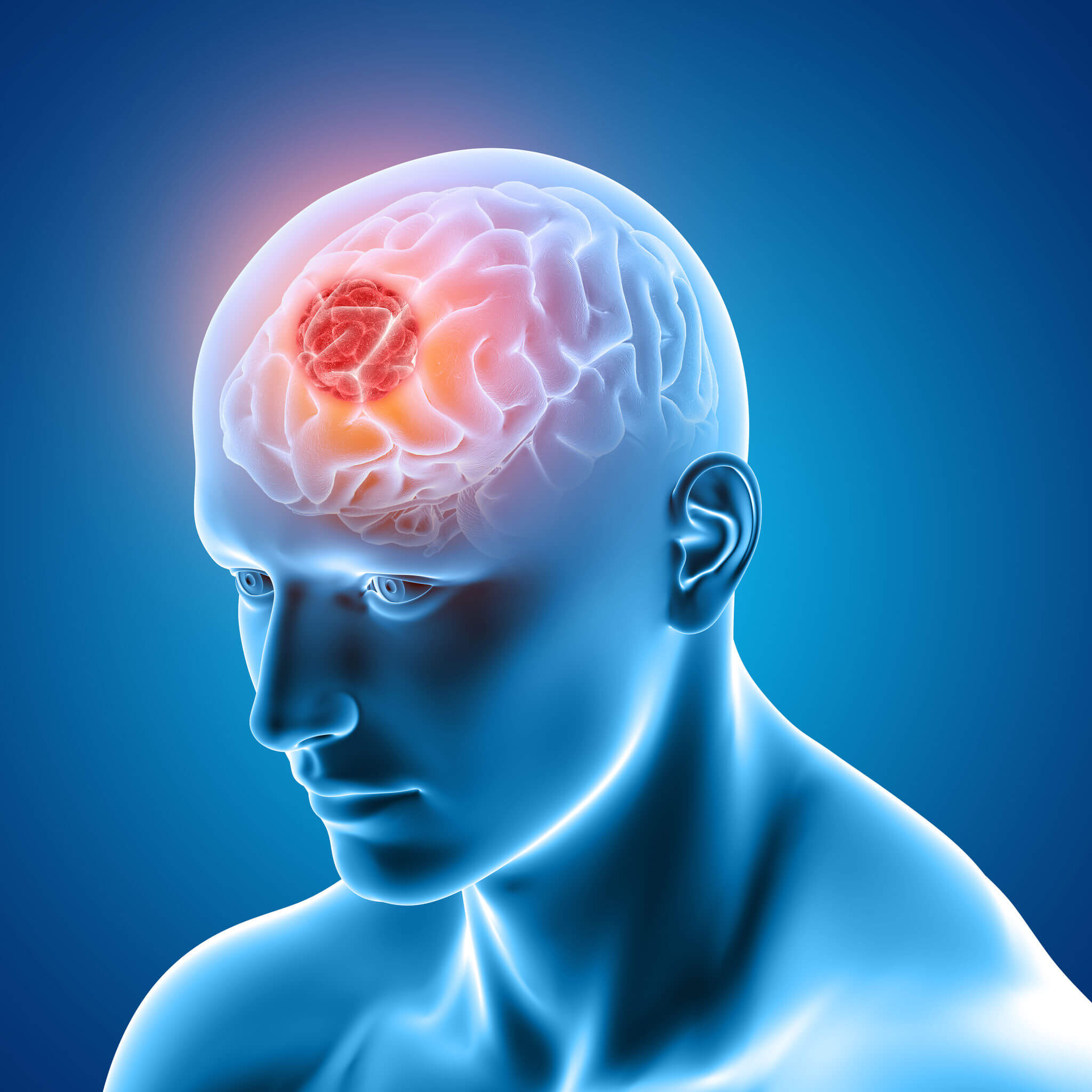 ¿Qué es el glioma cerebral?