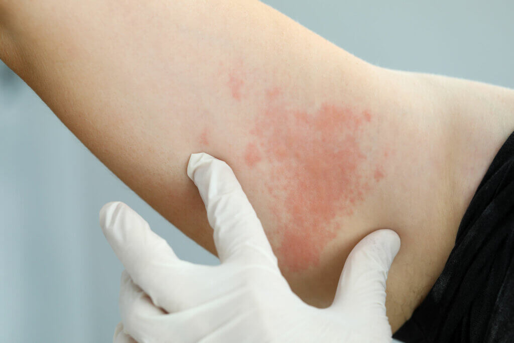 Contact dermatitis on the skin.