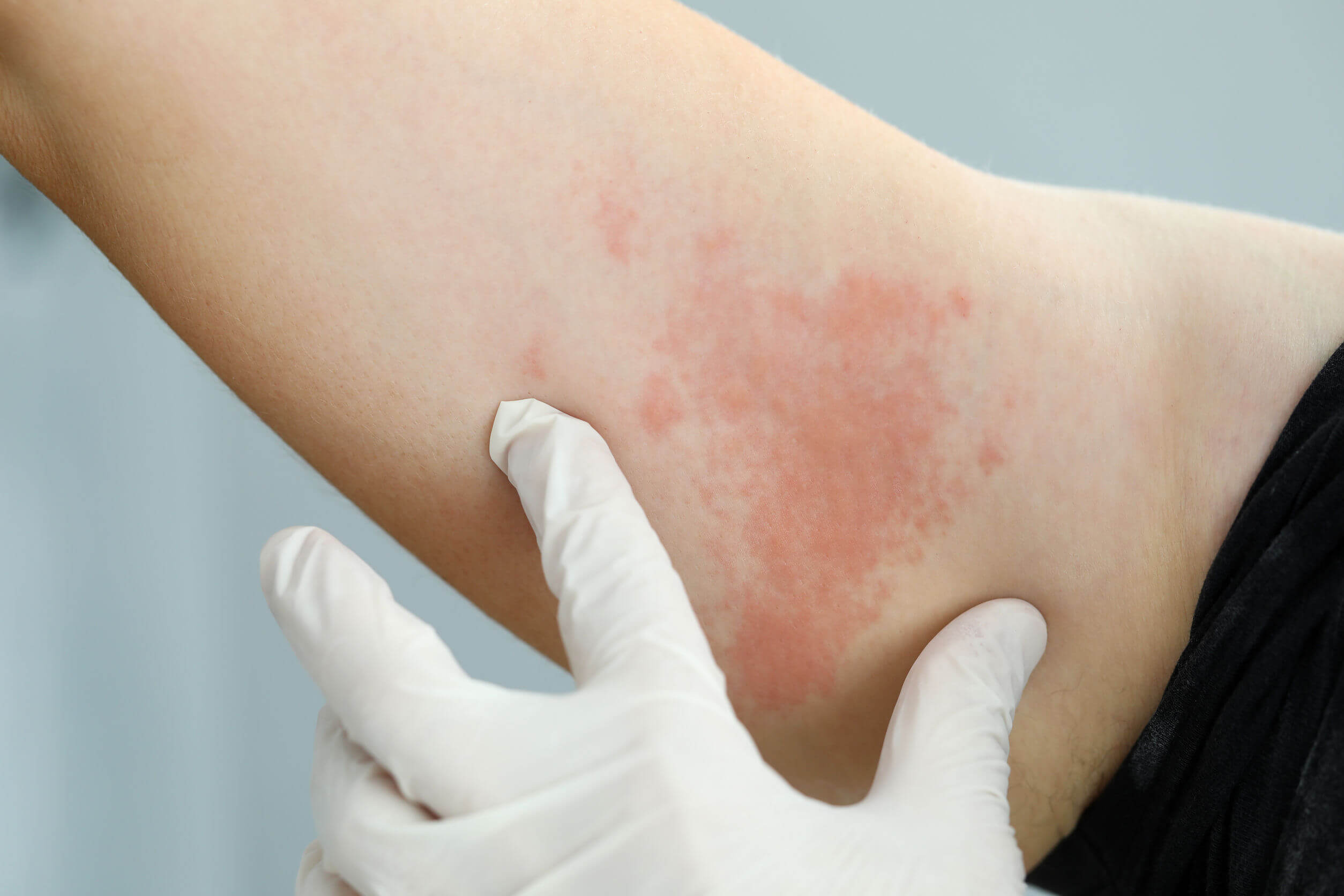 Os sintomas de anafilaxia incluem reações na pele