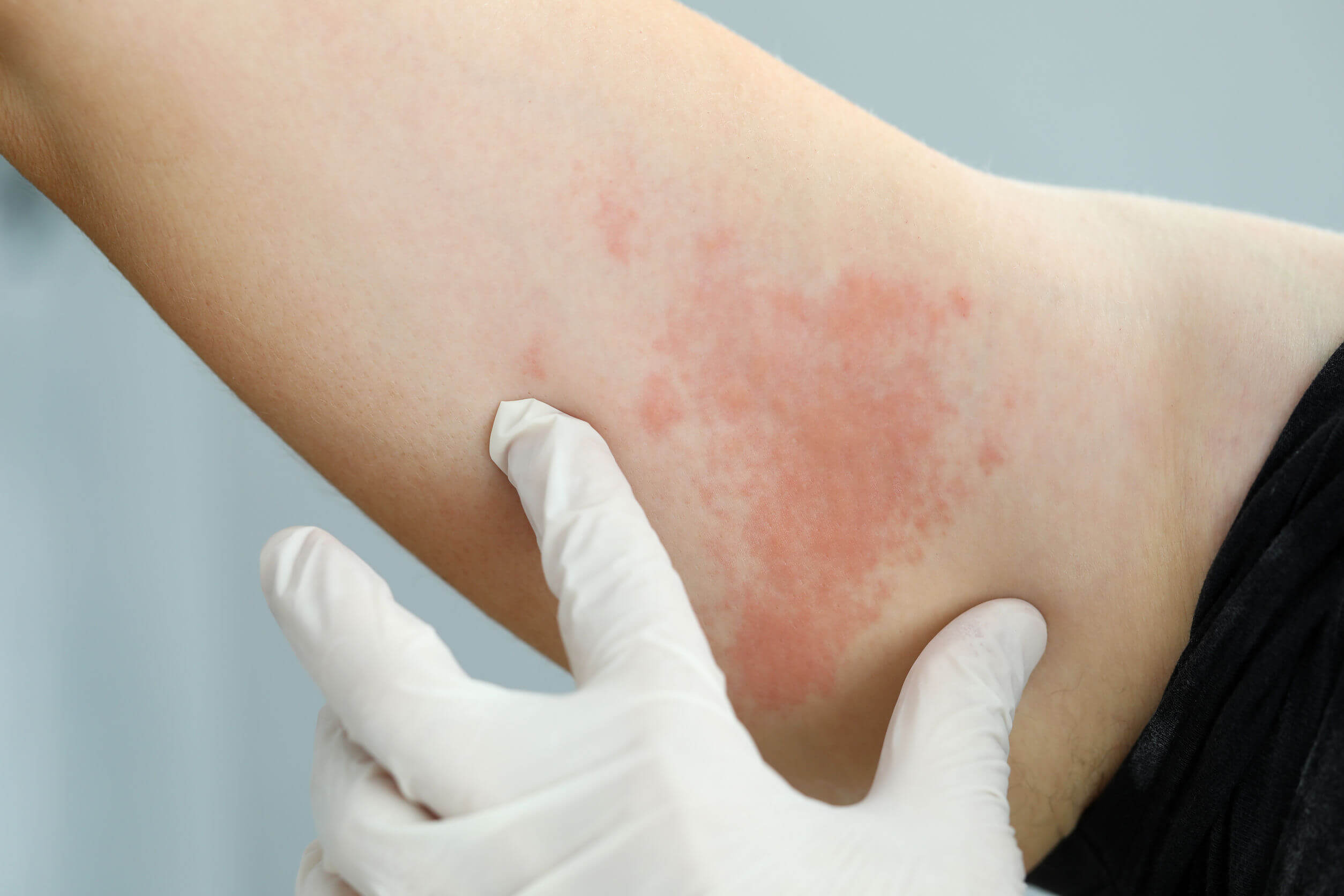 La alergia al gluten es poco probable