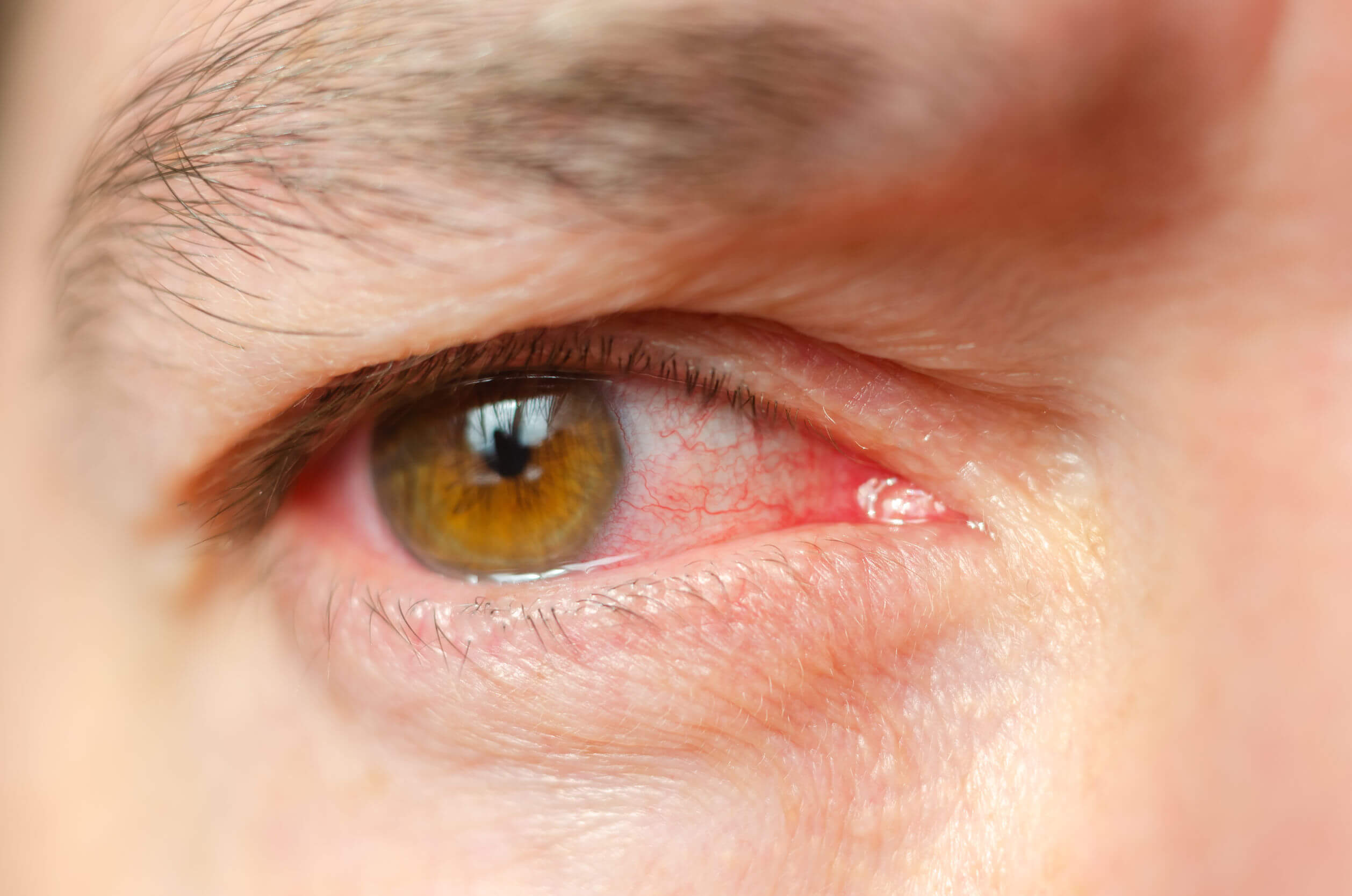 O glaucoma pode causar vários sinais e sintomas.