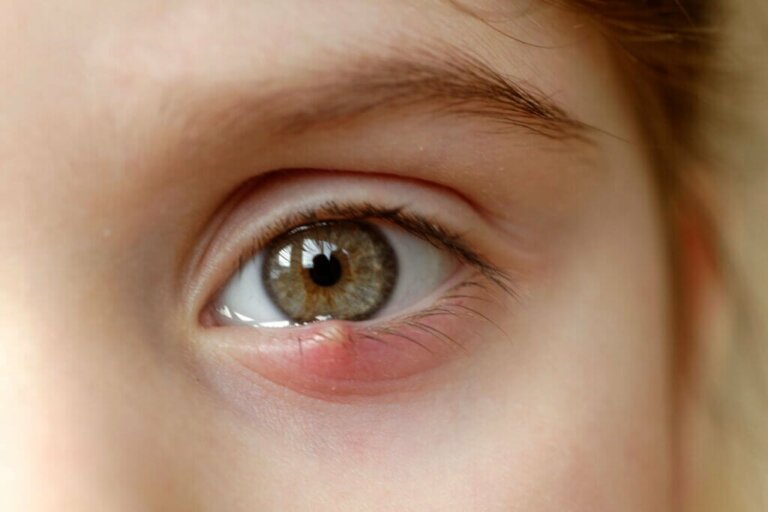 Styes: Symptoms, Causes and Treatment