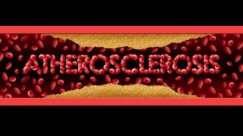 L'athérosclérose est une maladie courante.