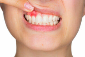 Gingivitis: síntomas, causas y tratamiento