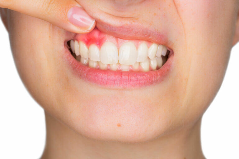 Gingivitis: síntomas, causas y tratamiento