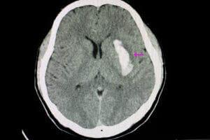 Diferencias entre aneurisma y derrame cerebral