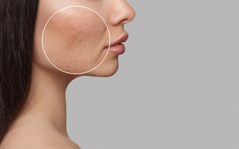 Los 8 tipos de acné