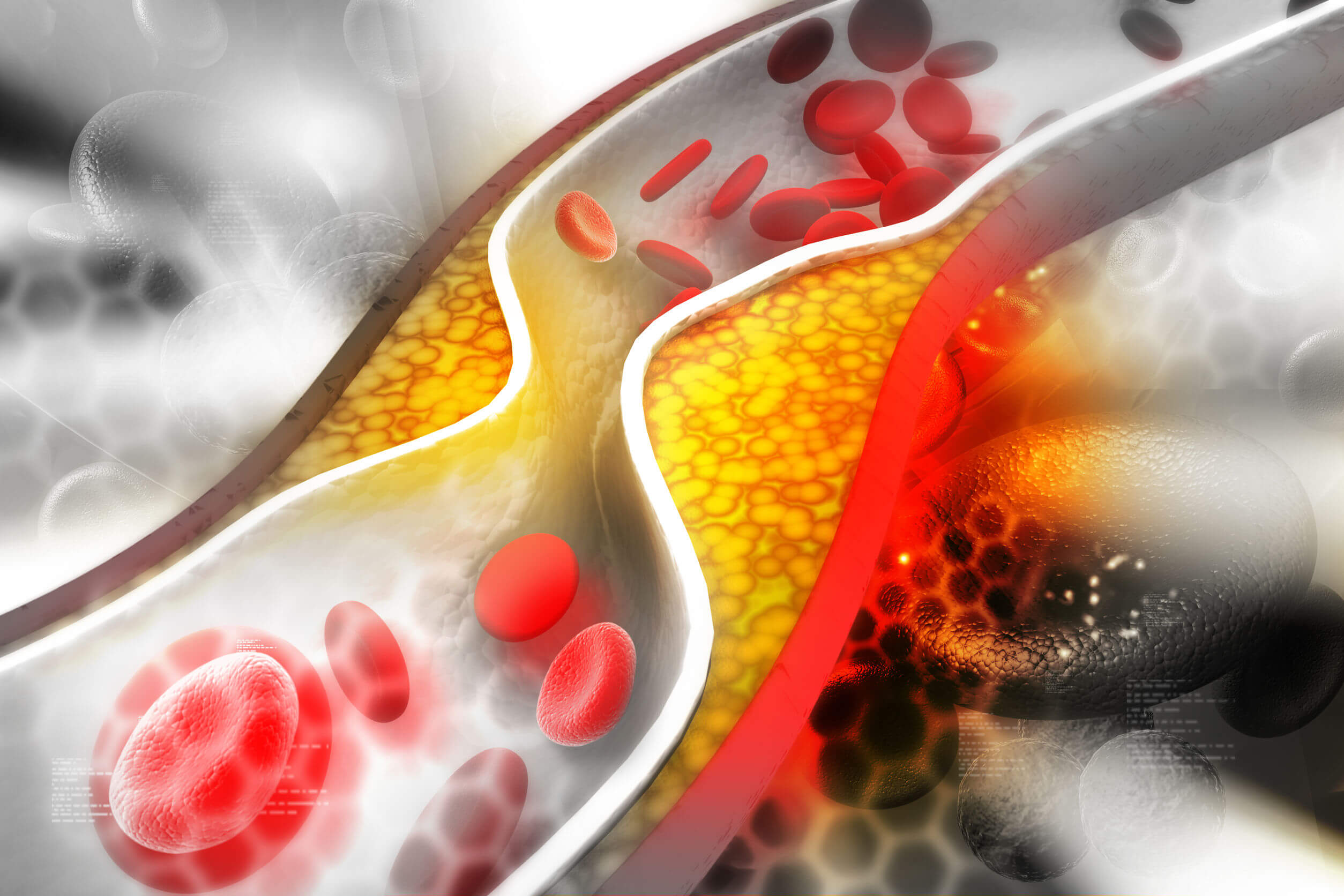Livelli elevati di colesterolo sono collegati al rischio di sviluppare aterosclerosi