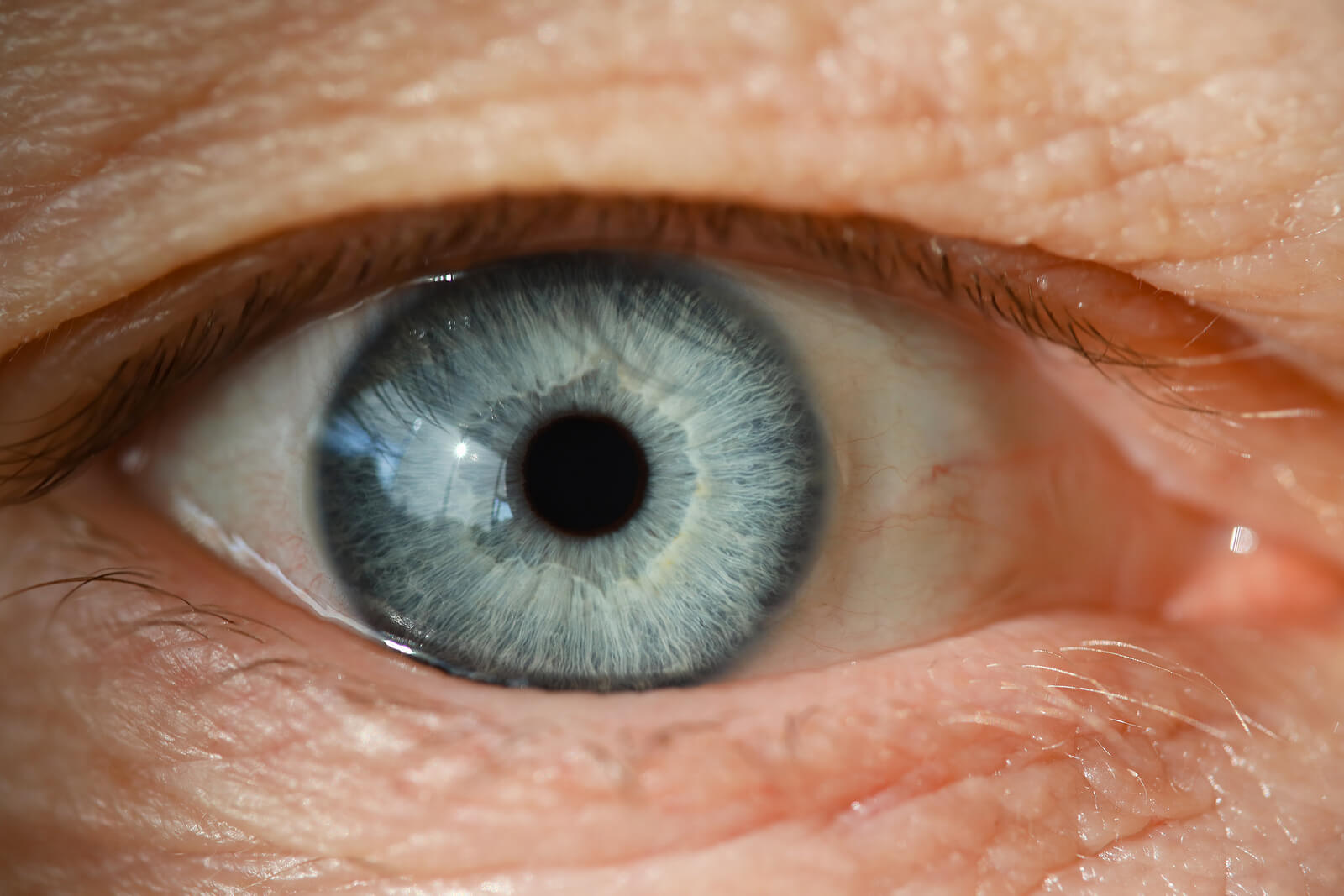 La cataracte est un problème oculaire courant.