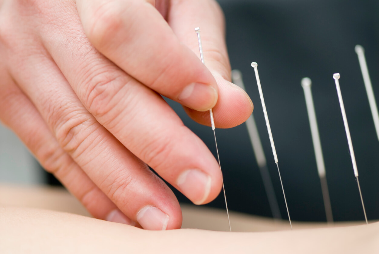 A acupuntura pode ser eficaz para a fibromialgia.