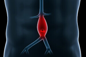 ¿Qué es un aneurisma?