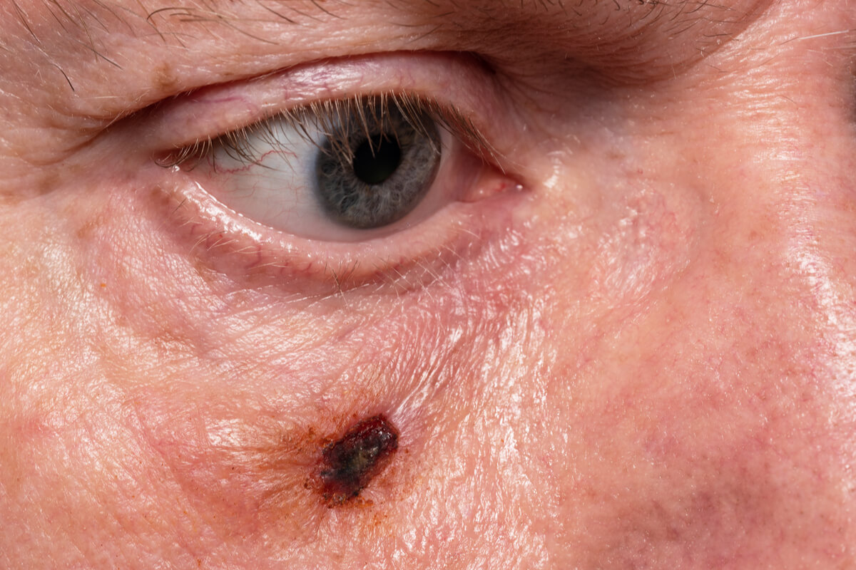 Dermoscopy is useful in cases of skin cancer