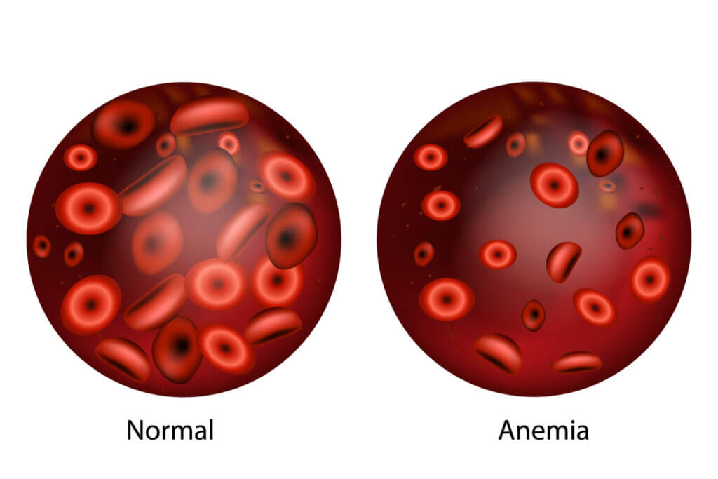 Glóbulos rojos en la anemia.